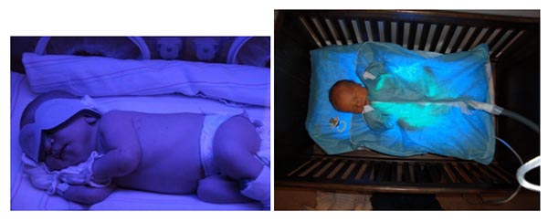 A baby at a hospital and a baby in a crib being treated with blue light therapy for jaundice